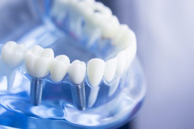 dental implants west hollywood ca